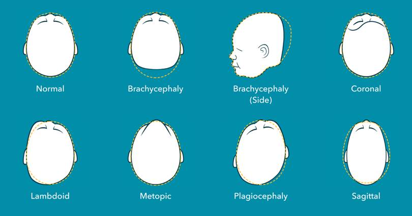 deformational plagiocephaly flat head syndrome examples