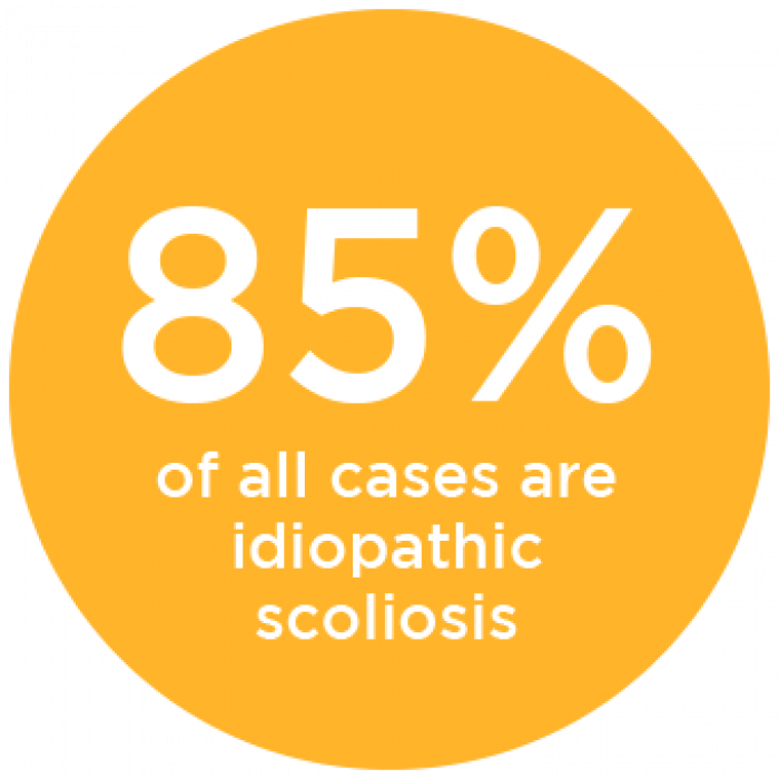 85 Percent of All Cases are Idiopathic Scoliosis