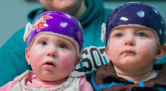Twins Teegan and Orion wearing the Gillette CranioCap orthosis (baby helmet).